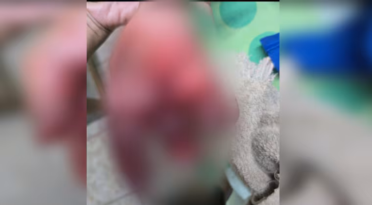 Itapúa: amputan parte del dedo a niño de 8 años tras sufrir explosión de petardo