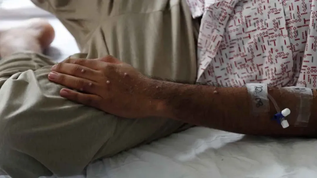 Paraguay se mantiene sin casos de viruela del mono, según Salud